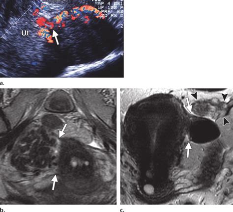 Exophytic Subserosal Leiomyoma In A 47 Year Old Woman A Endovaginal Download Scientific