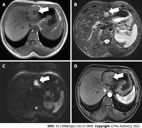 High Frame Rate Contrast Enhanced Ultrasound Findings Of Liver Metastasis Of Duodenal