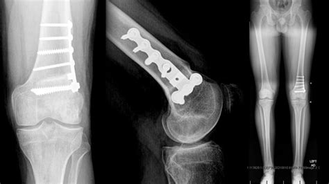 Arthrex Lateral Meniscal Allograft Transplantation With Distal Femoral Osteotomy And Fresh