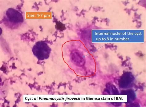 Pneumocystis jirovecii in Giemsa stain and its details