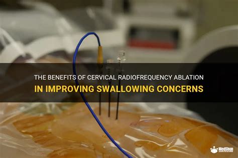 The Benefits Of Cervical Radiofrequency Ablation In Improving