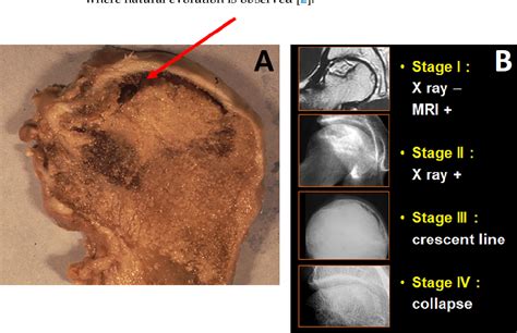 Figure 1 From Mesenchymal Stem Cell Therapy For Bone Repair Of Human