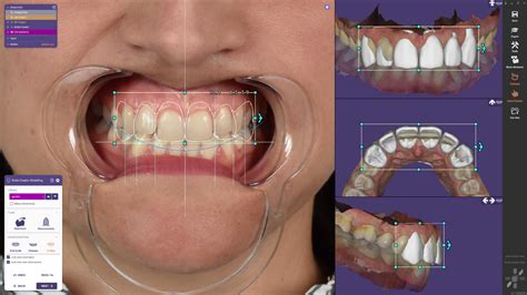 Smile Creator Exocad