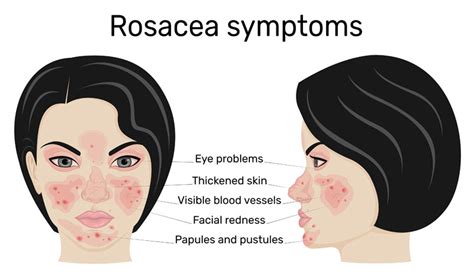 Understanding Two Types Of Rosacea Skin And The Eyes