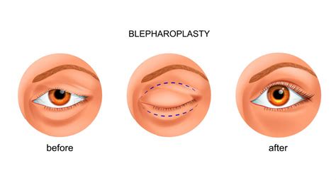 Eyelid Surgery Auburn Blepharoplasty Tacoma Evergreen Eye