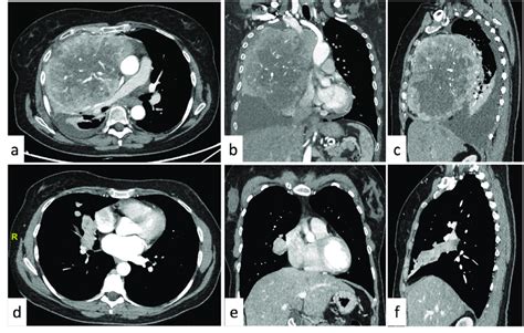 Mediastinal Neuroendocrine Tumor NET Vs Lung Carcinoid A C