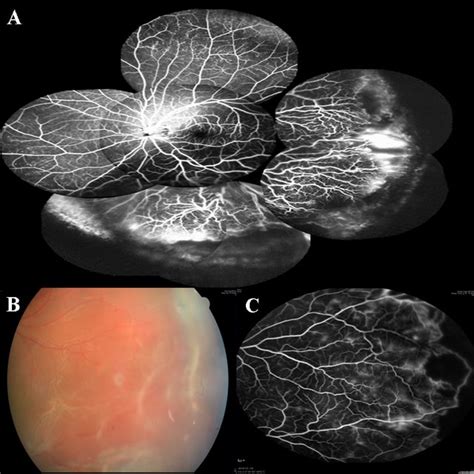 Color Fundus And Fa Photos Of Group 3 Eyes A Fluorescein Angiography Download Scientific