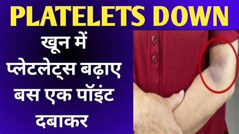 Acupressure Points For Platelets Platelets Badhane Ka Gharelu Upayhow