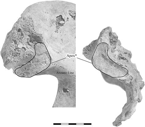 Preauricular Sulcus