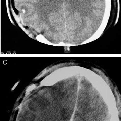 A Axial Ct Scan Showing Left Hemispheric Brain Edema Associated With A