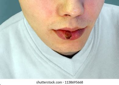 Syphilis Images Stock Photos D Objects Vectors Shutterstock