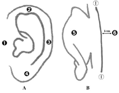 The Auricle Is Divided Into Six Zones A The Lateral Surface Of The Ear