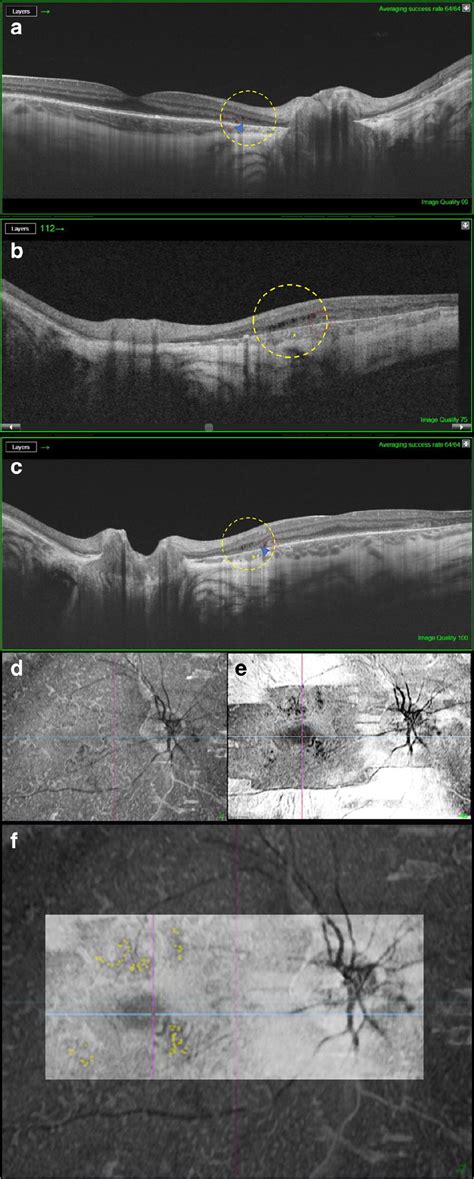 A B C Long Oct Scans Mm Show Cystoid Spaces In Inner