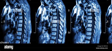 Spine Metastasis Cancer Spread To Thoracic Spine Mri Of Cervical