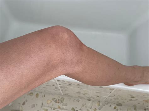 Tinea Versicolor Arm