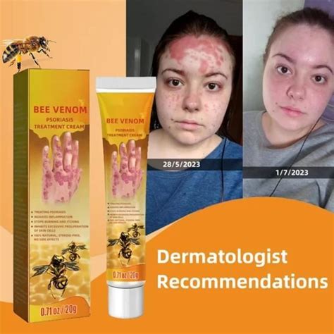 Venin D Abeille Professionnel Psoriasis Traitement Cr Me Apaisant