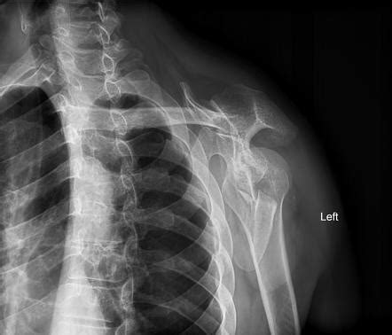 Scapular Comminuted Fracture Image Radiopaedia Org