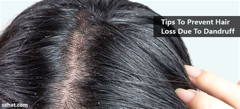 How To Prevent Hair Loss Due To Dandruff