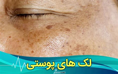 لک های پوستی صورت و بدن و کک مک چیست؟ علت و درمان فایند کلینیک