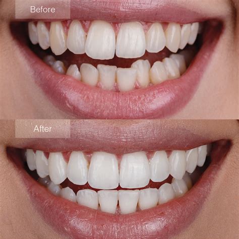 Smile Gallery View Before And After Of Treatment On Real Patients