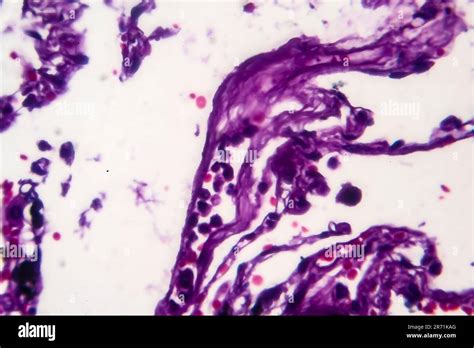 Histopathology Of Smoker S Lung Light Micrograph Showing Accumulation