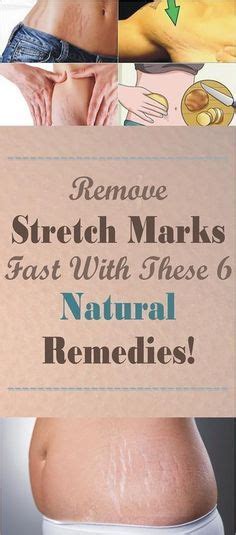 To Find Out How To Remove Stretch Marks Fast With These 6 Natural