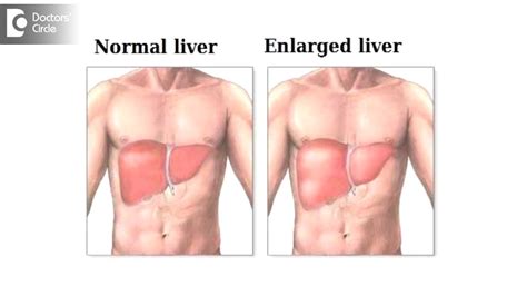 How Long Will It Take For An Inflamed Liver To Heal Dr Nanda