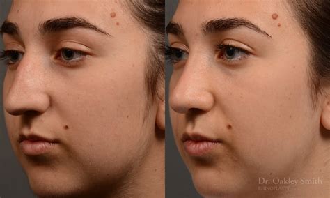 Dr Oakey Smith Top Rhinoplasty Surgeon Toronto Case 418