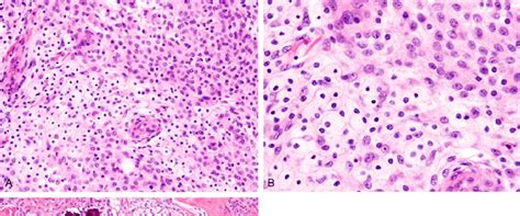 Hemangioblastoma Foamy Cells