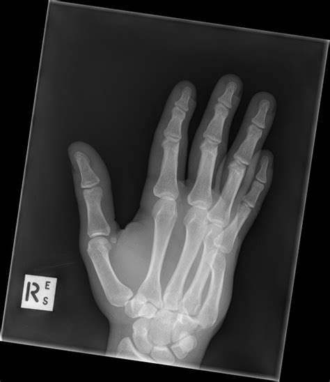 Carpometacarpal Joint Dislocation Pacs