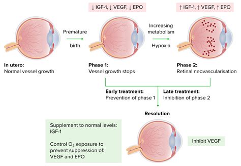 Retinopathy Of Prematurity Concise Medical Knowledge