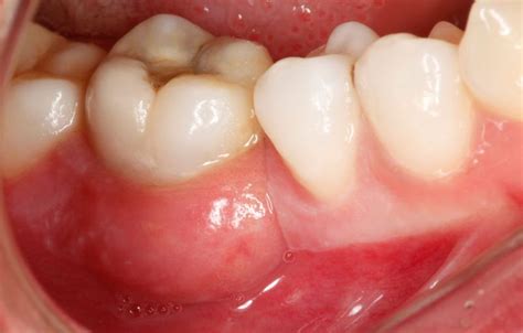 Absceso Dental Qu Es Causas Y Tratamiento Bqdc