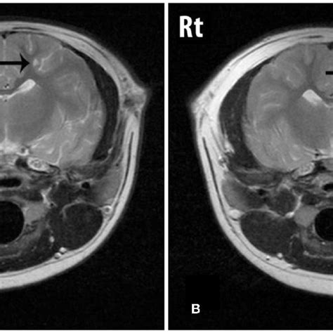 T2w Transverse Images Through The Cerebrum Showing A Lesion Arrow Download Scientific