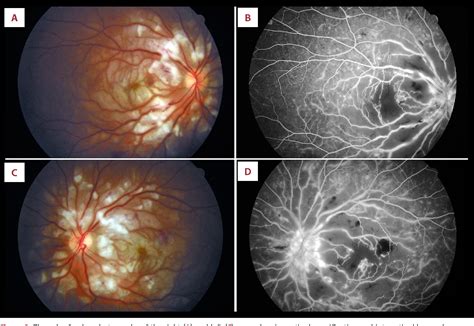 Figure 2 From Eosinophilic Granulomatosis With Polyangiitis Presenting