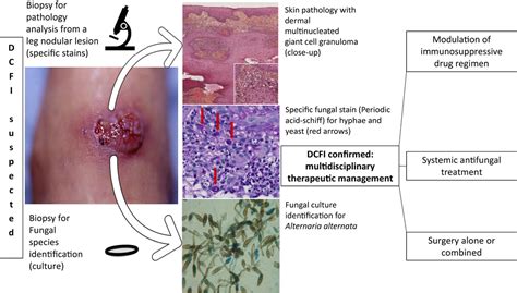 Deep Cutaneous Fungal Infections In Solid Organ Transplant Recipients