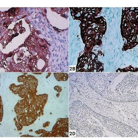 Immunohistochemistry A Ck Positive B Ca Positive C Ck