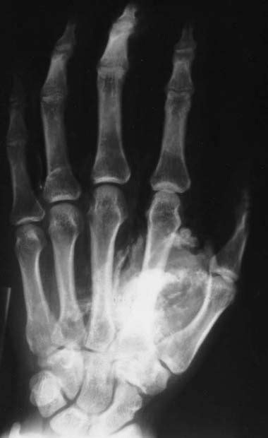 High Pressure Cement Injection Injury Of The Hand A Case Report Journal Of Hand Surgery