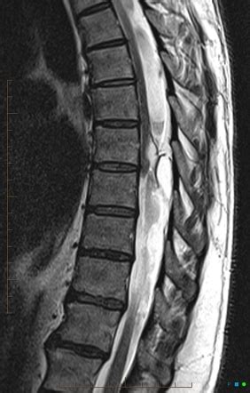 Lateral Thoracic Meningocele Radiology Case Radiopaedia Org