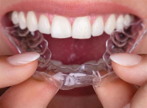 Straighten Your Teeth With Invisible Braces « Smile Team Orthodontics