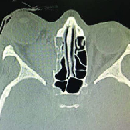 Right Retrobulbar Hematoma Black Arrow Taken From The Radiological