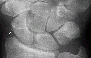 Scaphoid fracture