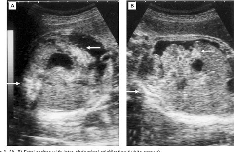 Figure From Meckel S Diverticulum Induced Intrauterine