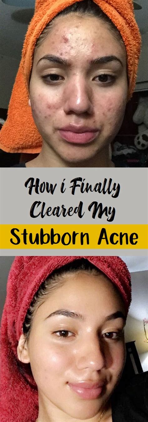 How I Finally Cleared My Stubborn Acne How To Beauty