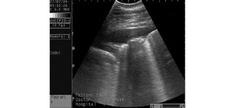 Fig B 24 Sonogram Of A Lung Of A Cow With Moderate Pleural Effusion