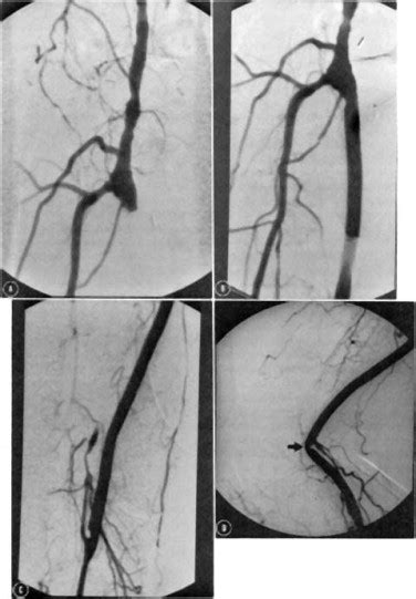 Salvage Of Occluded Arterial Bypass Grafts By Means Of Thrombolysis Journal Of Vascular Surgery