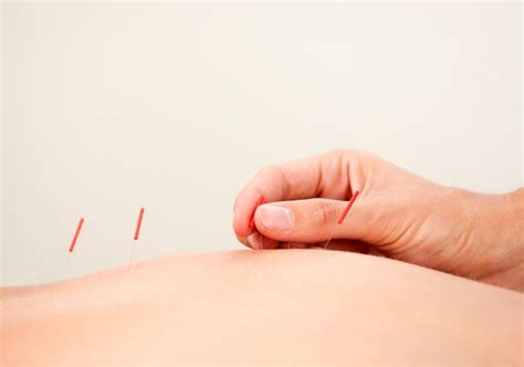 Benefits Of Acupuncture Therapy Oliver Chiropractic Wellness Clinic Yeg