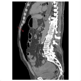 Abdominal Computed Tomography Scan Axial Section Showing Massive Free