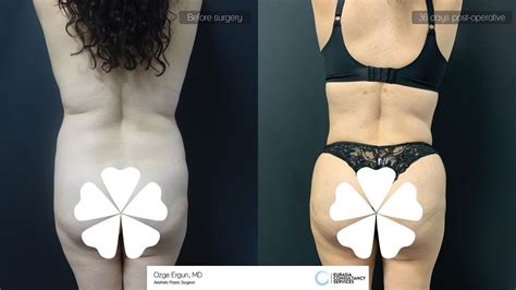 Vaser Liposuction Before After 36 Days Result Ozge Ergun MD