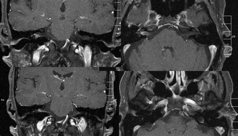 Ramsay Hunt Syndrome