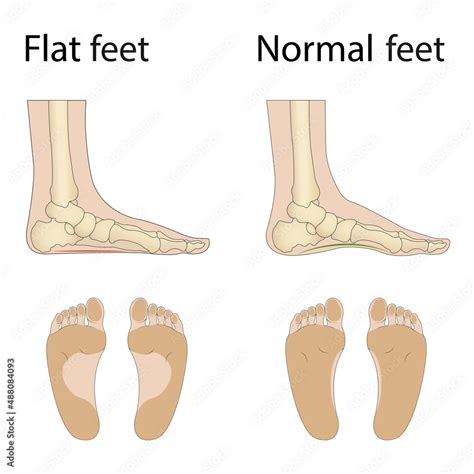 Foot deformity types, medical disease infographics. Hollow, flat, and normal foot. Vector ...